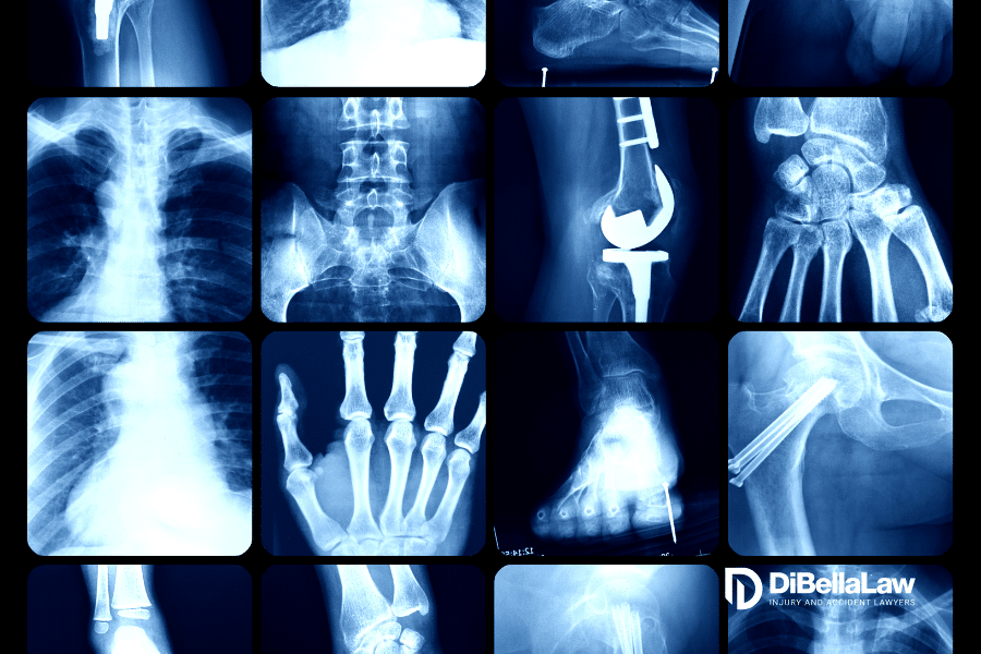 collection of x-rays showing various injuries from accidents around Massachusetts